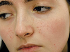 Ayurveda Skin Care Treatment Bangalore India