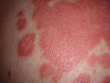 Ayurveda Treatment for Psoriasis Bangalore India